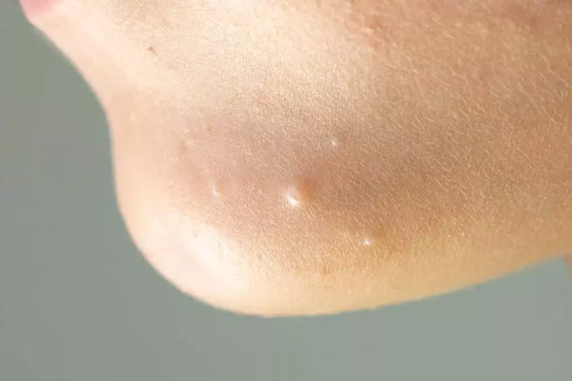 "Molluscum Enfeksiyonu: Ciltteki İnci Benzeri Şişlikler, Gizli Tehlike!"