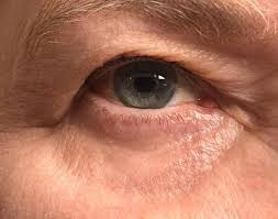 Uzmanlar Uyardı: Göz Kapağı Sarkması Günlük Hayatı Felç Ediyor