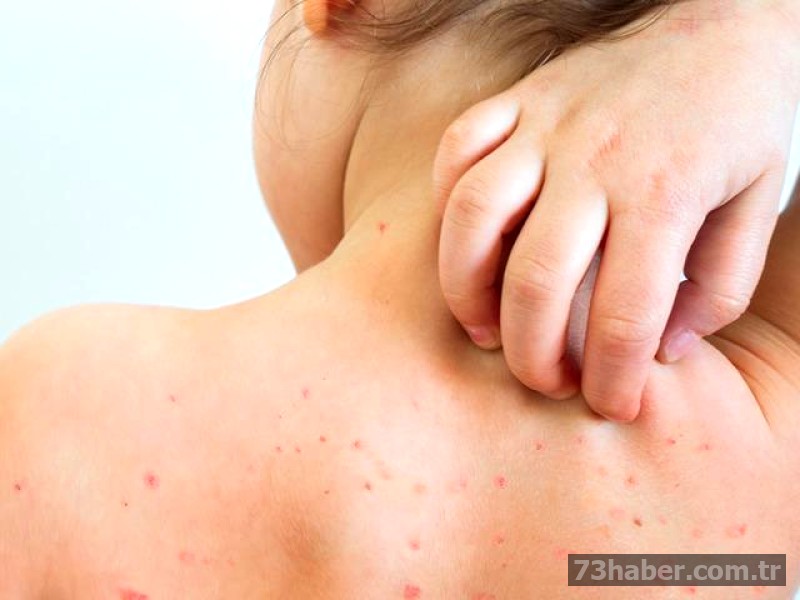 Okullarda suçiçeği alarmı! Veliler tedirgin: Bu belirtiler varsa dikkat