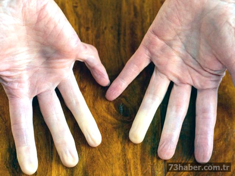 Cilt renklerinde değişiklik tehlike işareti