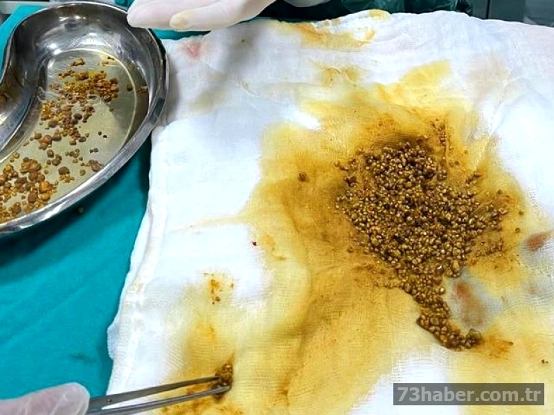 Safra Taşı Rekoru Kırdı