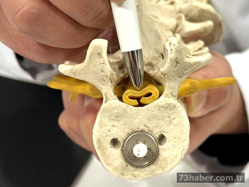 Sinsi Bel Ağrısı Tehlikesi