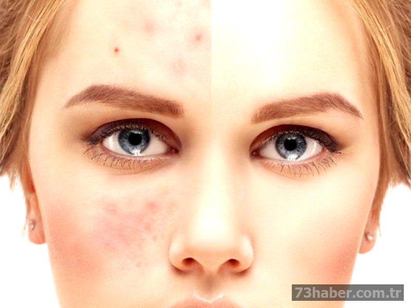 Gül Hastalığı Tehlikesi